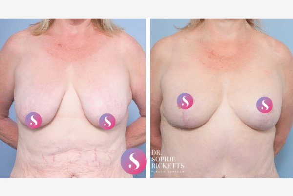 Breast Lift (Mastopexy)