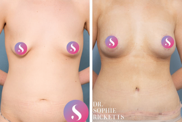 Breast Lift (Mastopexy) & Augmentation