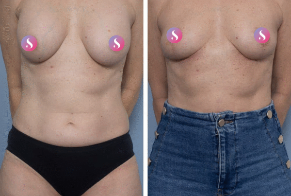 Breast implant removal & Breast Lift (Mastopexy)