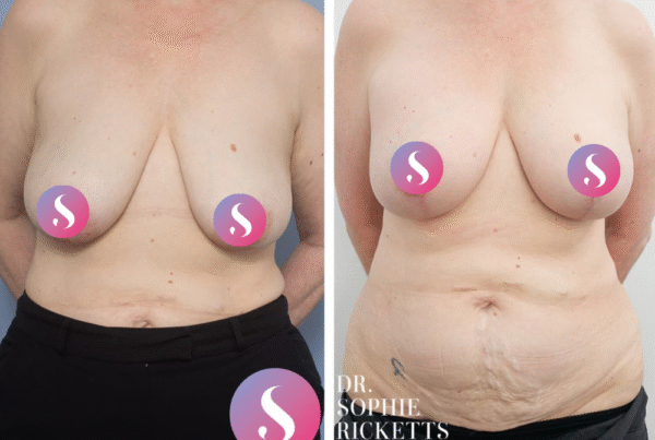 Breast Lift (Mastopexy) & Augmentation