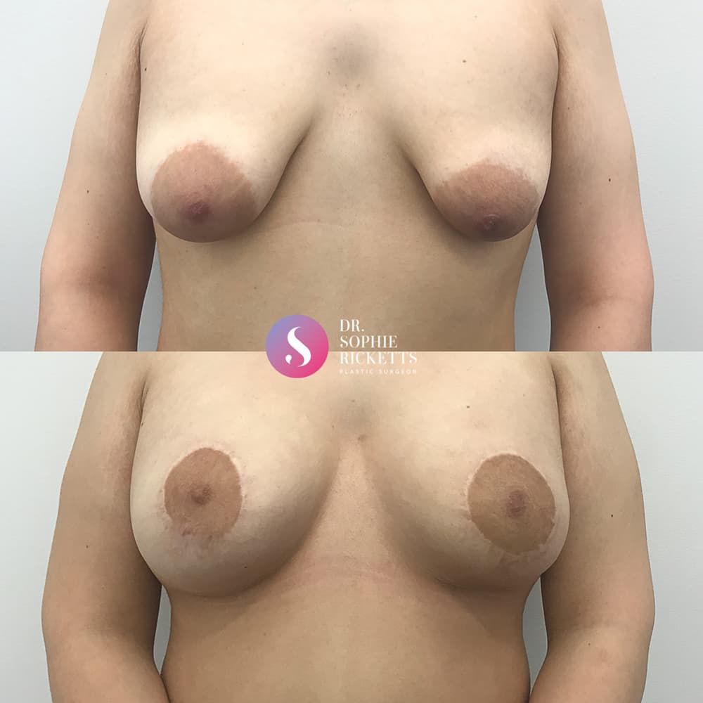 Breast Lift (Mastopexy) & Augmentation