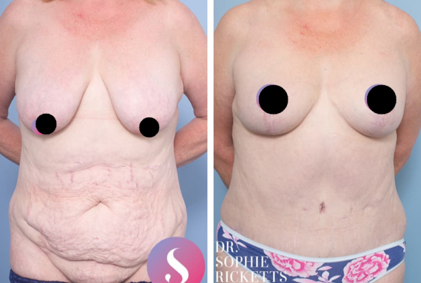 Breast Lift + Abdominoplasty