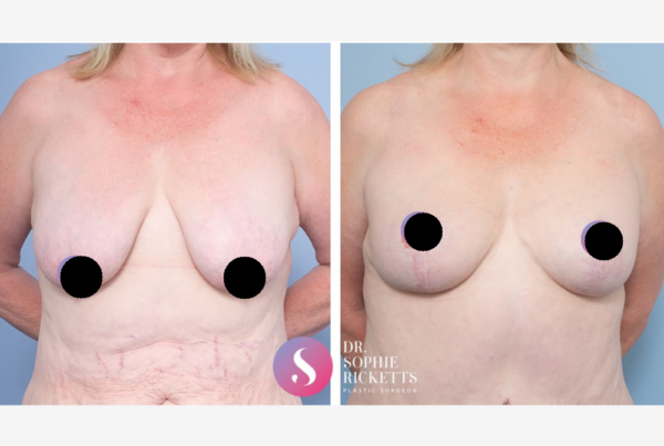 Breast Lift (Mastopexy)