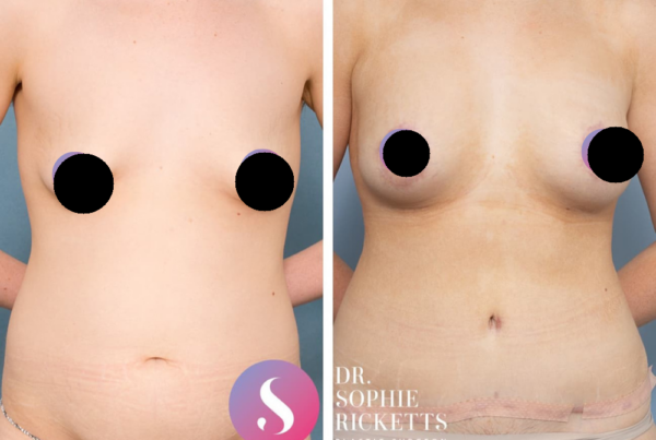 Breast Lift (Mastopexy) & Augmentation
