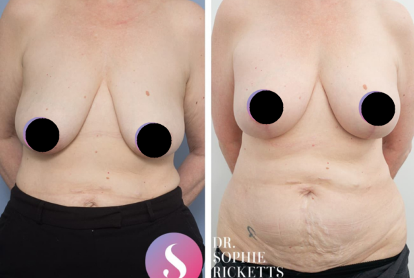 Breast Lift (Mastopexy) & Augmentation