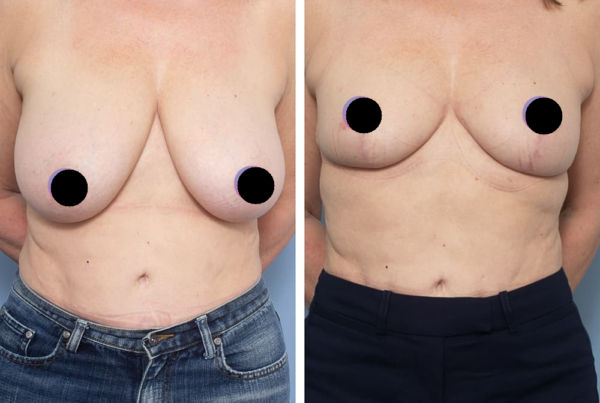 Breast Reduction