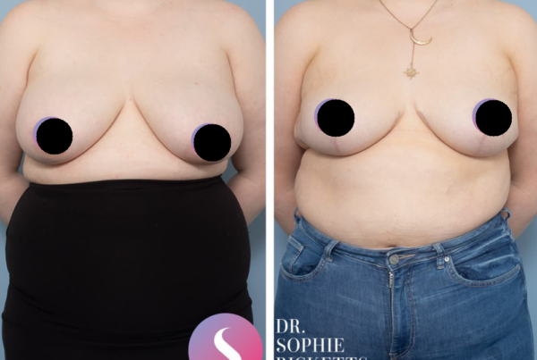 Breast Reduction