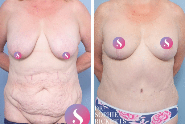 Abdominoplasty and Breast Lift (Mastopexy)