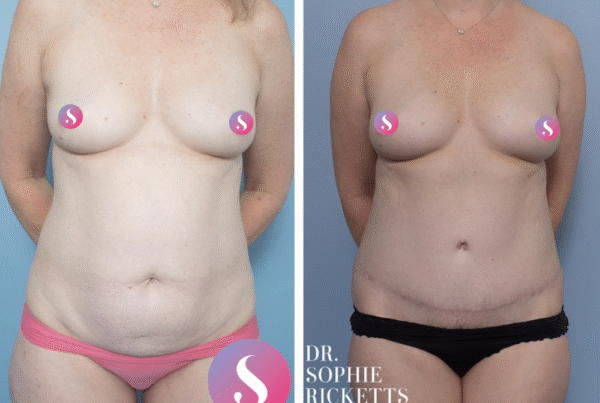 Abdominoplasty