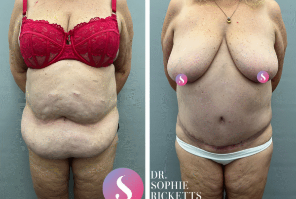 Abdominoplasty