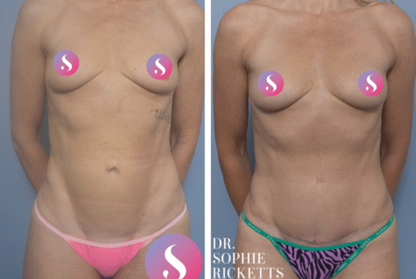 Abdominoplasty