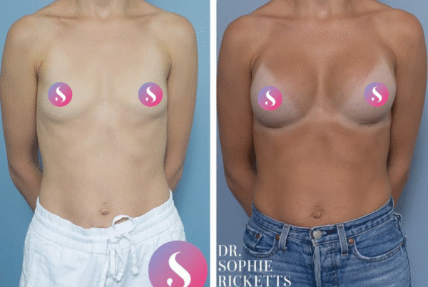 Breast Augmentation