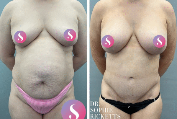 Post Pregnancy Surgery