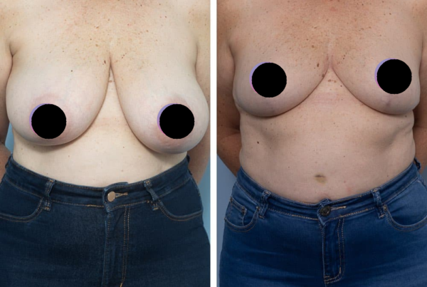 Breast Reduction