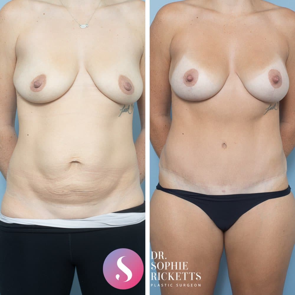 Breast Lift (Mastopexy) & Implants + Abdominoplasty
