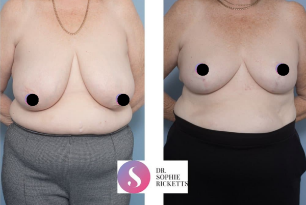 Breast Reduction