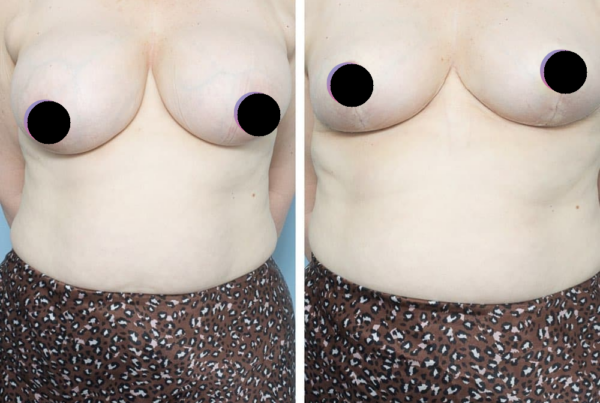 Breast Reduction