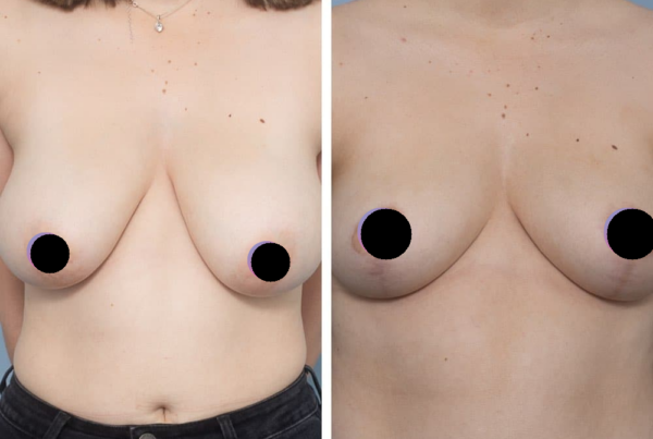 Breast Reduction