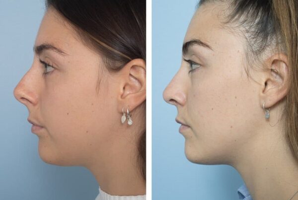 Open Rhinoplasty