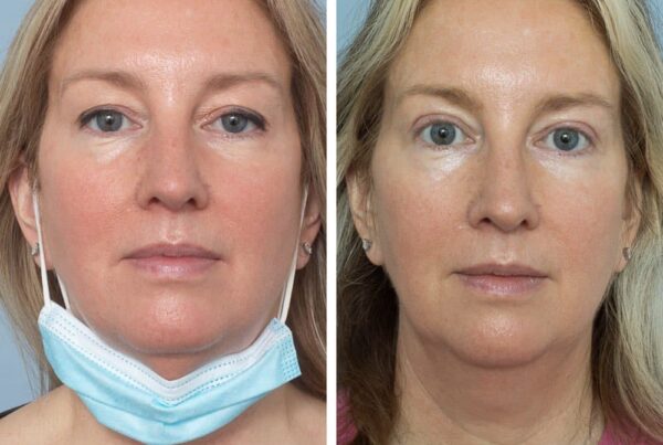 Blepharoplasty