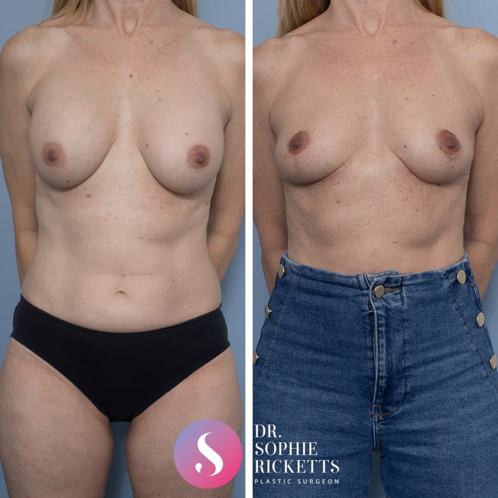 Breast implant removal & Breast Lift (Mastopexy)