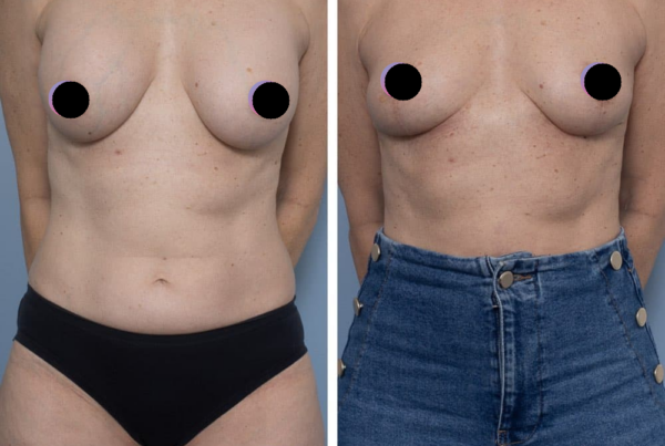 Breast Implant Removal & Breast Lift (Mastopexy)