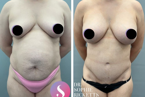 Post Pregnancy Surgery