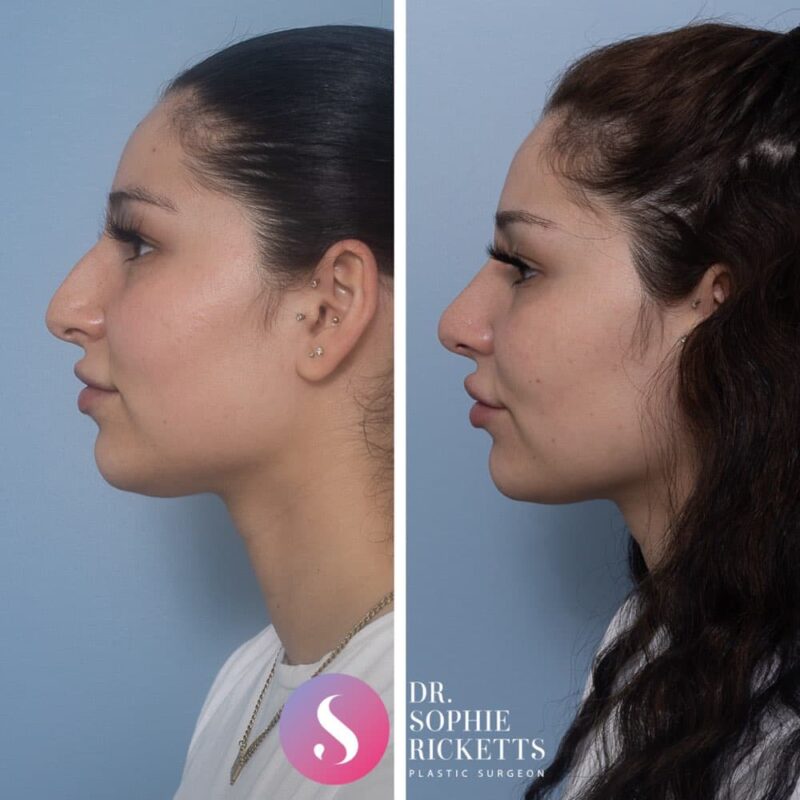 Rhinoplasty | Dr. Sophie Ricketts - Plastic Surgeon
