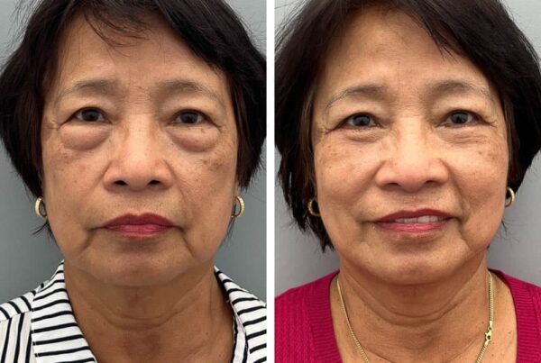 Lower Eyelid Blepharoplasty