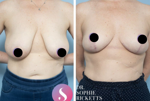 Breast Reduction