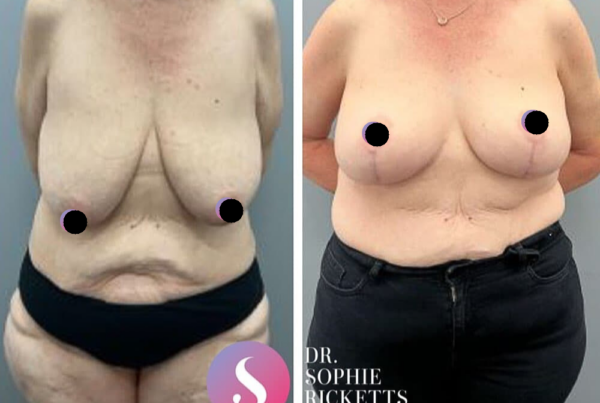 Breast Reduction