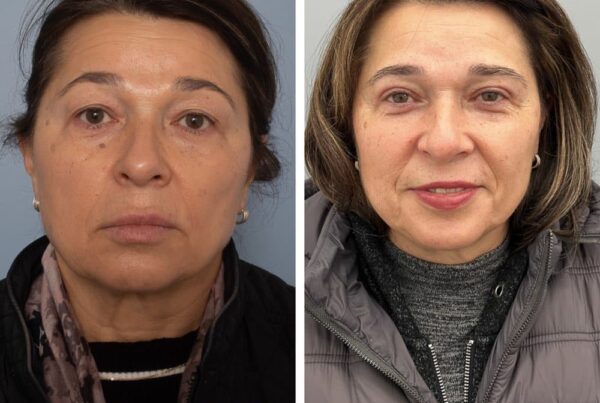Upper Eyelid Blepharoplasty