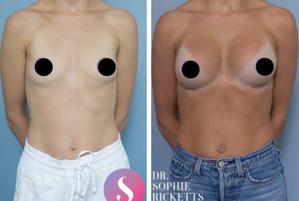 Breast Augmentation
