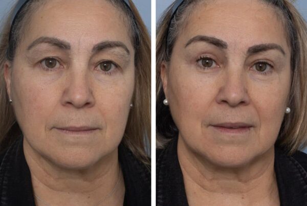 Browlift & Upper Eyelid Blepharoplasty
