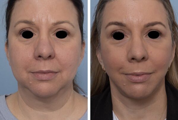 Face and Neck Lift Surgery