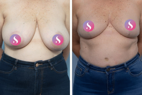Breast Reduction