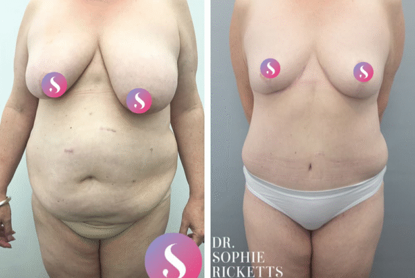 Post Pregnancy Surgery