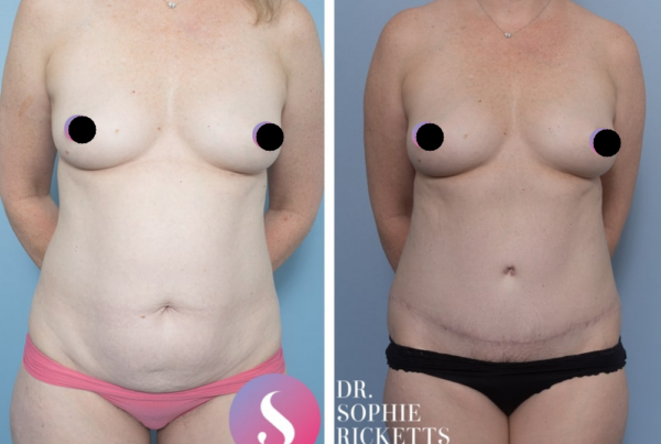 Post Pregnancy Surgery