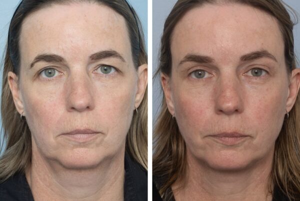 Temporal Brow lift and Upper Blepharoplasty