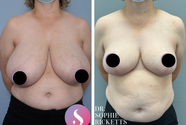 Breast Reduction