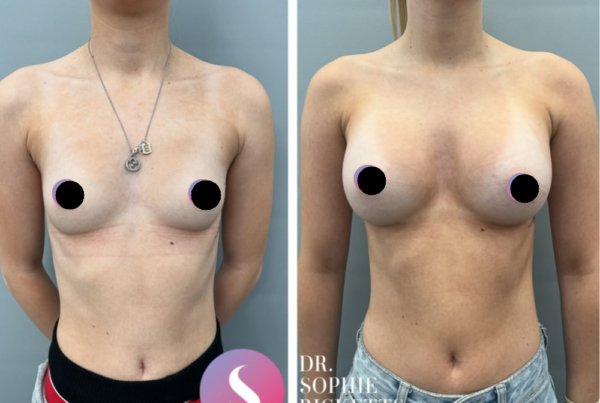 Breast Augmentation