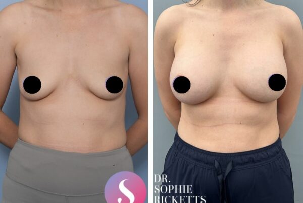 Breast Augmentation