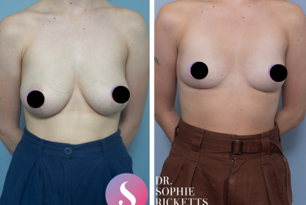 Breast Reduction