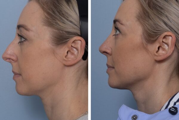 Rhinoplasty