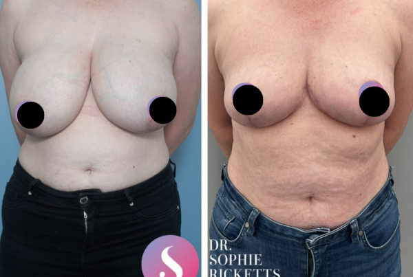 Breast Reduction