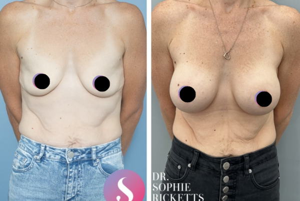 Breast Augmentation