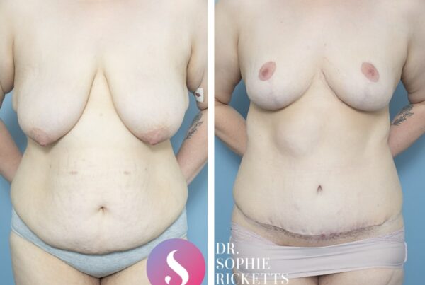 Abdominoplasty and Breast Reduction