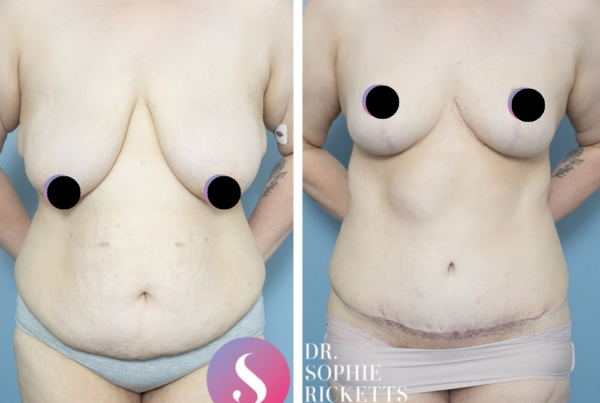 Post Pregnancy Surgery