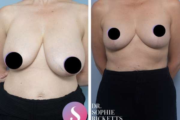 Breast Reduction