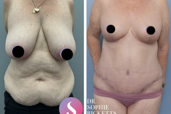 Breast Reduction + Abdominoplasty